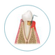 Icon zeigt Querschnitt von Zahn mit Zahnfleisch - Zellen bilden sich zurück